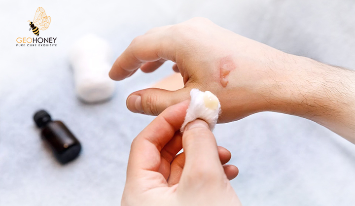 Potential Of Honey In The Treatment Of Wounds And Burns