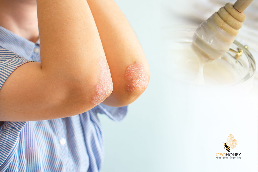 White Honey Can Make Eczema Buzz Off! Here’s How?